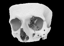 skull with add man implant