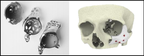 3D printed implants