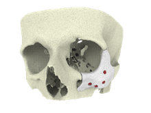 skull with add man implant