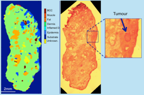 Cancer diagnosis and imaging by Raman micro-spectroscopy