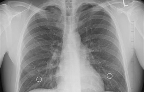 Lungs - Image from www.pixabay.com