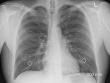 Lungs - Image from www.pixabay.com