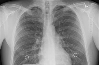 Lungs - Image from www.pixabay.com